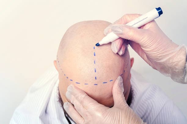 Hair Transplant Turkey Cost Compared to USA and UK