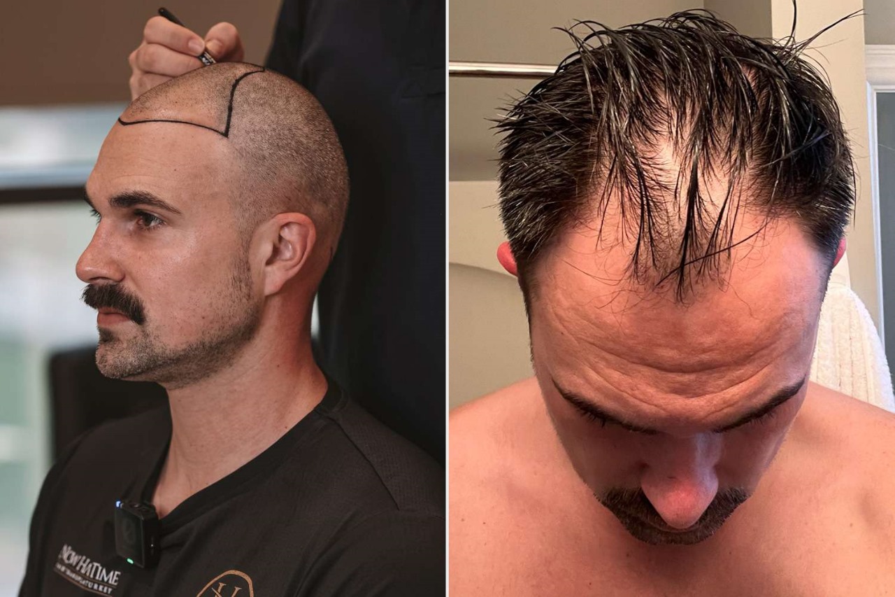 Modern Hair Transplant London Solutions for Men and Women