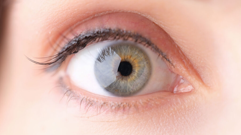 LASIK Turkey for Astigmatism: Complete Guide